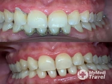 Compare Reviews, Prices & Costs of Root Canal in Greece at DUMITRIU DENT - Dr. Teodora Dumitriu | 755AEB