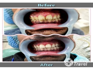 Compare Reviews, Prices & Costs of Arm Lift in Mysore at The Dental Port | 05FF1E