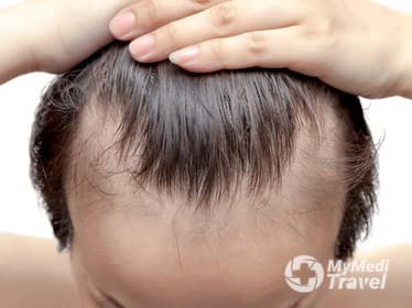 Compare Reviews, Prices & Costs of Eyebrow Hair Transplant in United States at Shapiro Medical Group | Hair Restoration | Minneapolis, MN | 875702