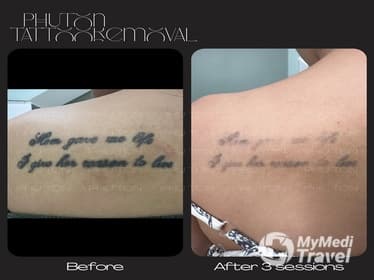 Compare Reviews, Prices & Costs of Gastric Sleeve in Vietnam at PHU TON - Laser Tattoo Removal | B3369E