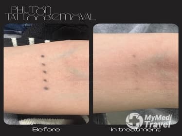 PHU TON - Laser Tattoo Removal