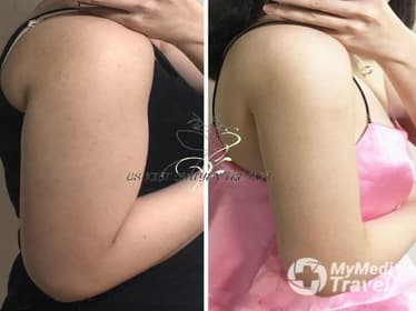 Compare Reviews, Prices & Costs of Dermal Fillers in Vietnam at Home Clinic | FF2A9E