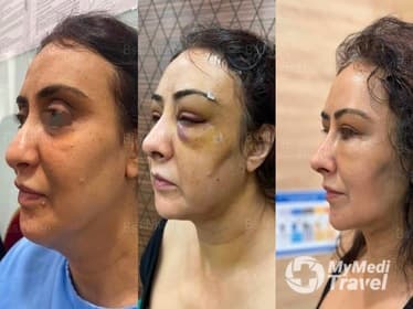 Compare Reviews, Prices & Costs of Dermal Fillers in Vietnam at Dr Nhan Ho Aesthetic and Plastic Surgery | 95A177