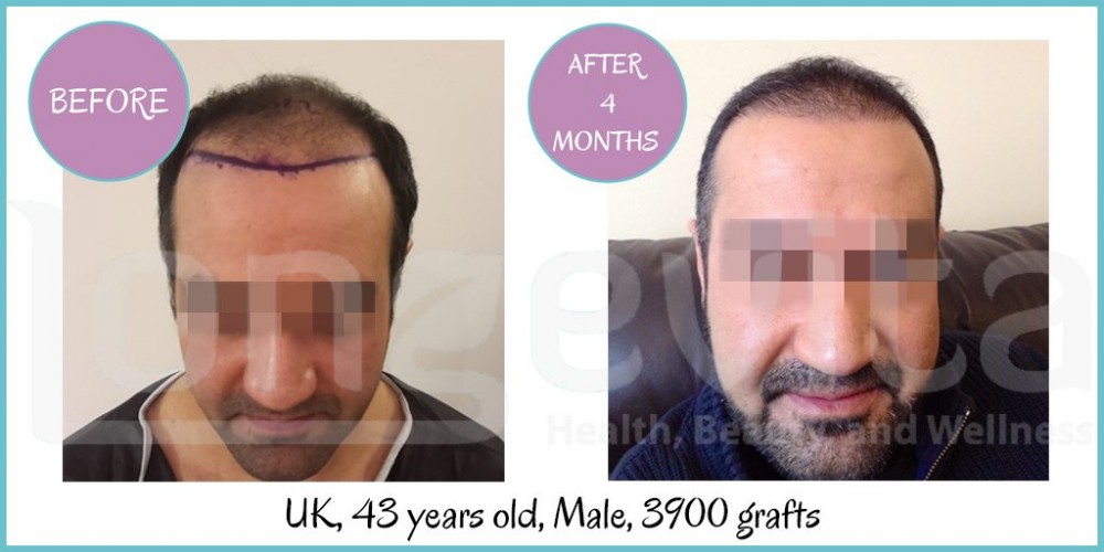 Longevita Hair Transplant - Izmir - Medical Center in Izmir | MyMediTravel