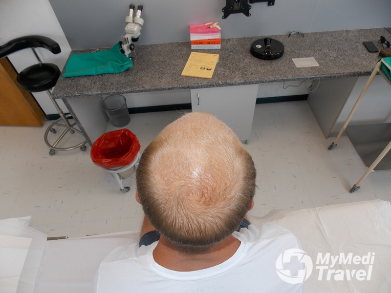 Hair Transplant at Medical Hair Restoration, Cape Town MyMediTravel