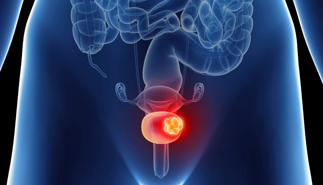 Bladder Cancer Treatment