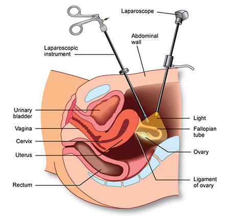 Gynecologic Laparoscopy