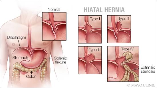 Hiatal Hernia Procedure