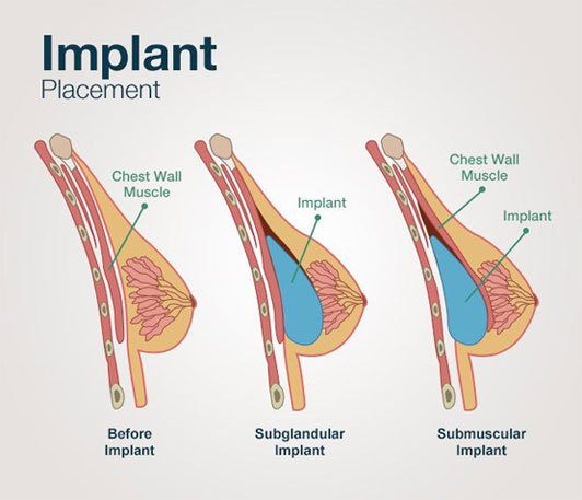 Update 10 things you should know before breast surgery And the most popular  breast implants of 2021 in Bangkok Thailand