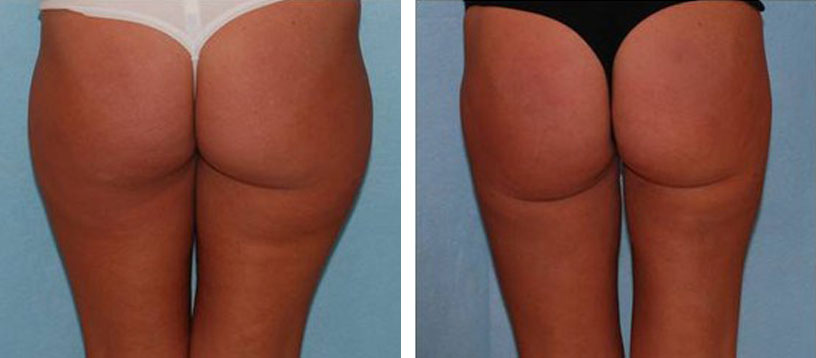 Thigh Lift before and After