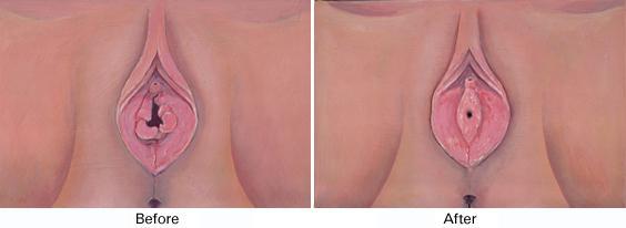 Hymenotomy Before and After