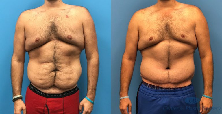 Body Lift Before and After