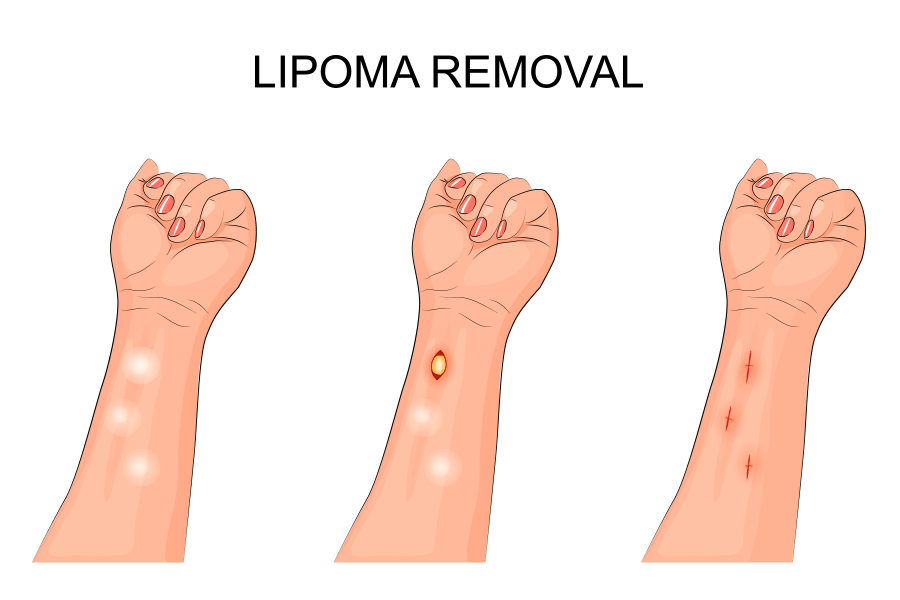 Cost to remove lipoma