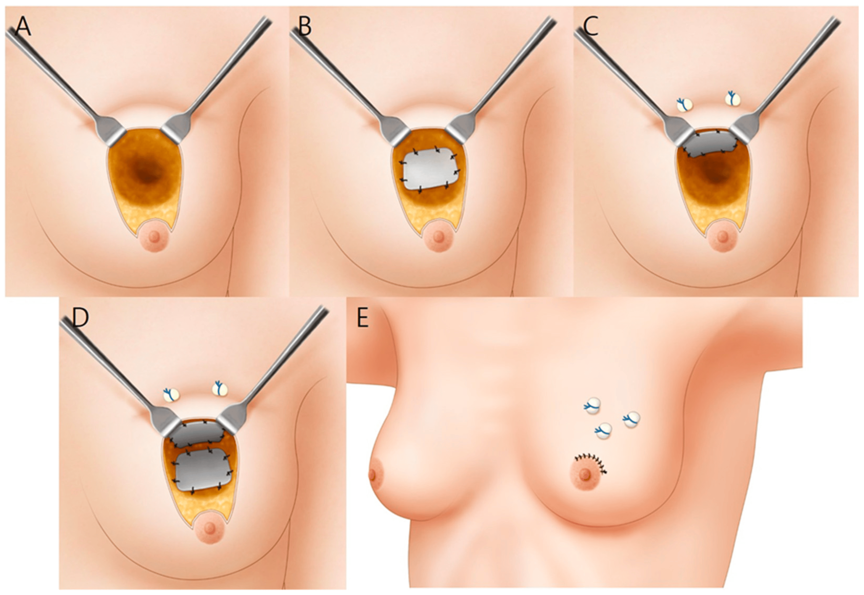 Types of Cysts in the Breast