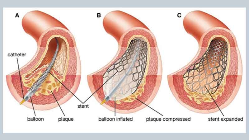 Placing of the Stent