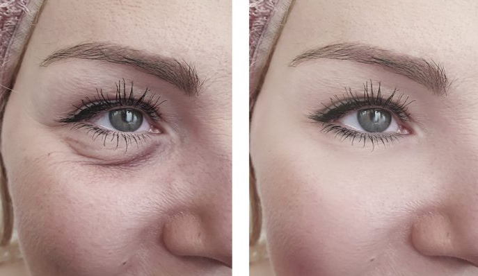 The Top 4 Alternatives to Blepharoplasty Surgery