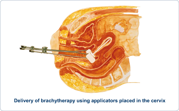 Brachytherapy Procedure