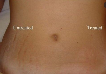 Stretch Marks Removal Before and After