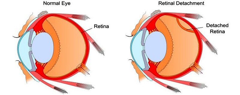 Normal Eye vs Retinal Detachment