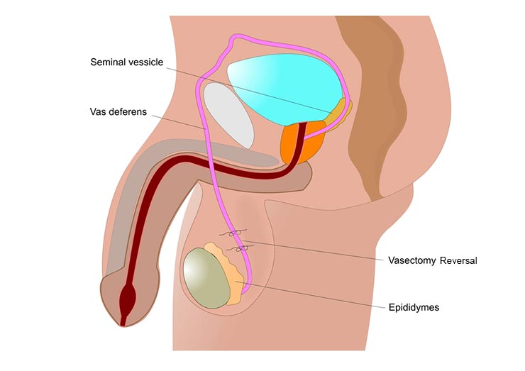 Reverse Vasectomy