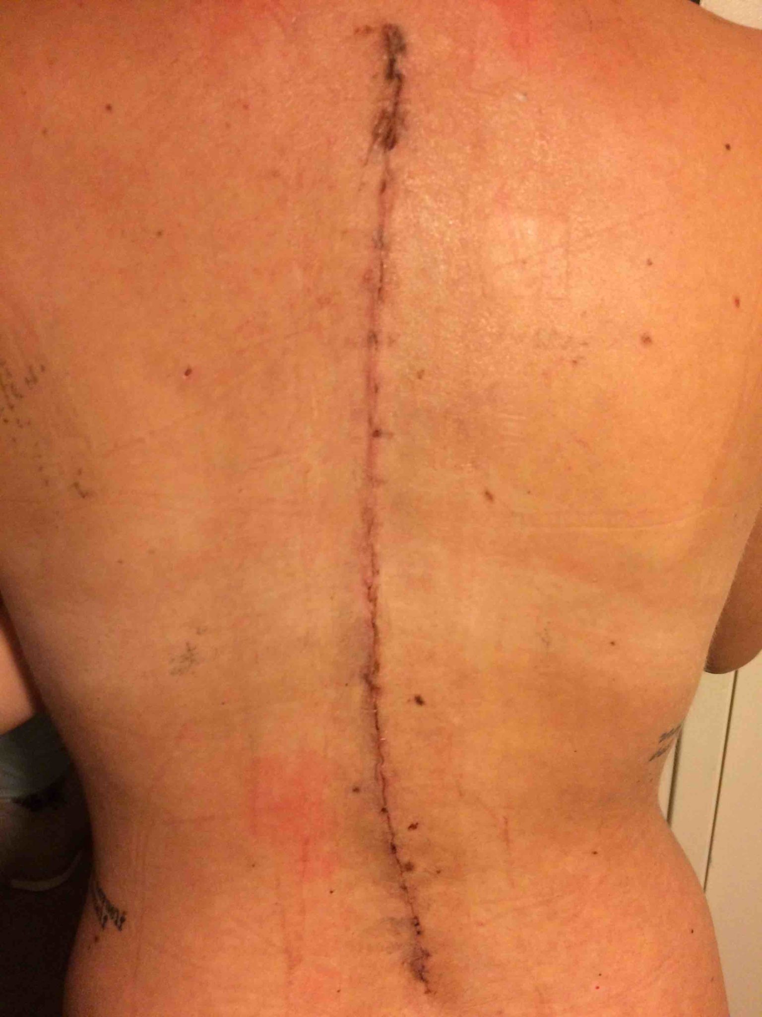 After Spinal fusion surgery