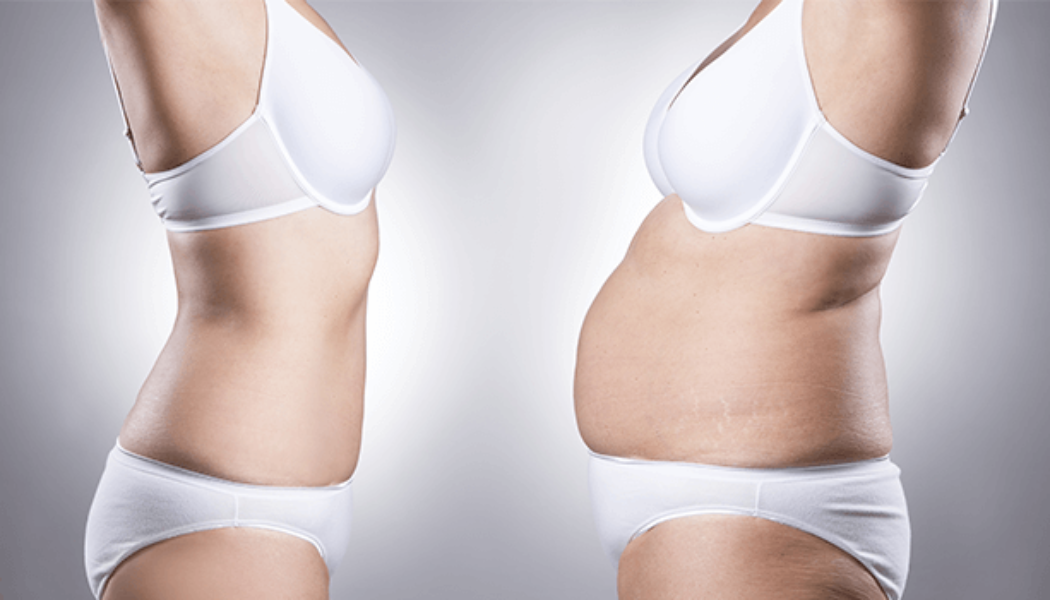 Vaser Liposuction Before and After