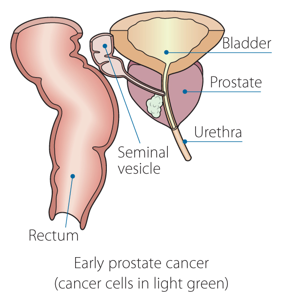 An early stage of Prostate Cancer