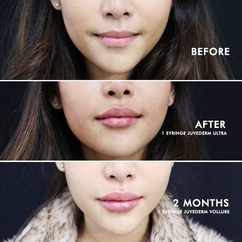 Lip Augmentation, Before and After Photos