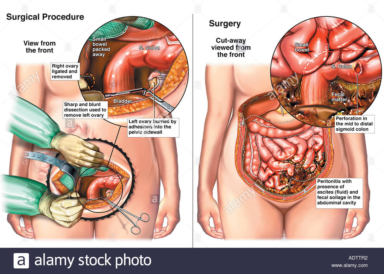 Ovariectomy Procedure
