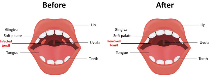 Tonsillectomy Before and After