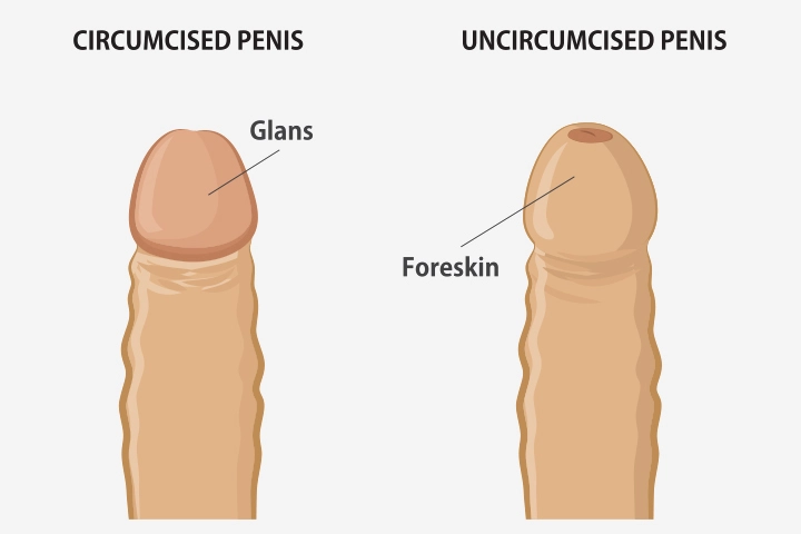Circumcision Before and After pro pic
