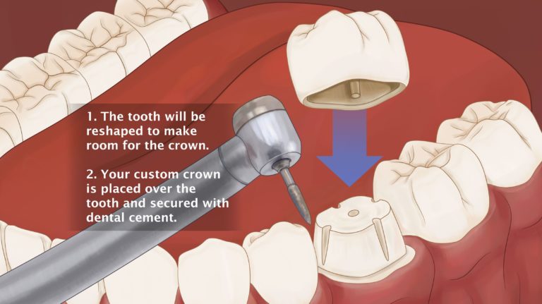 10 Best Clinics For Dental Crown In South Africa 2021 Prices
