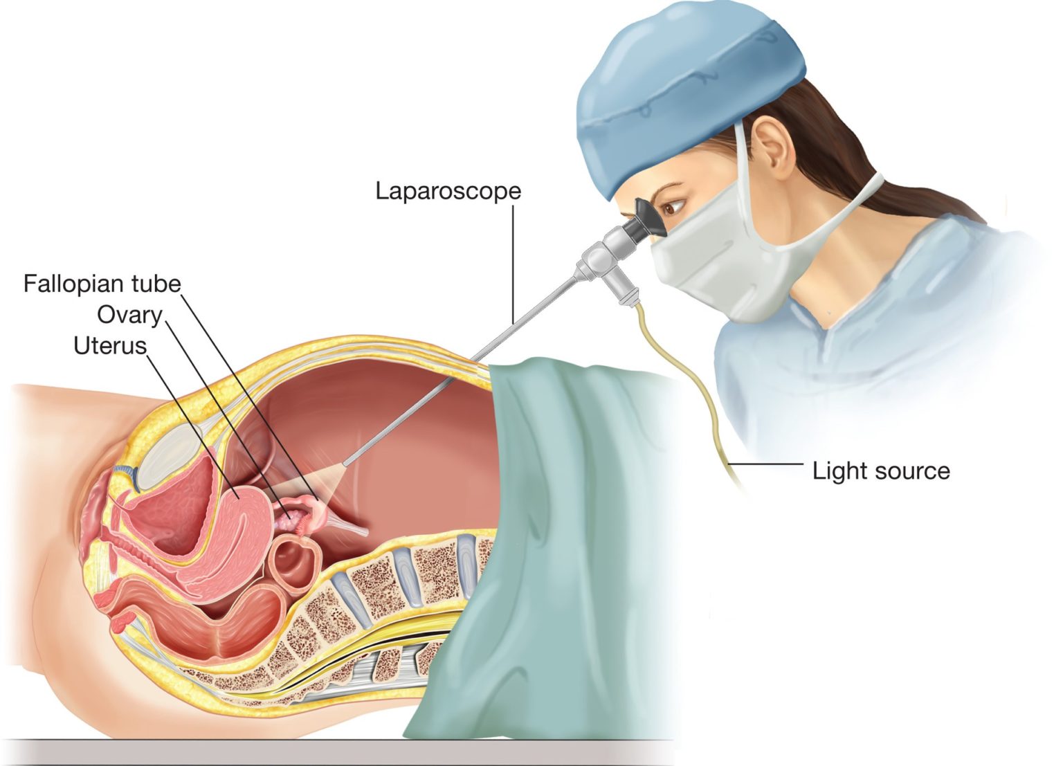 Diagnostic Laparoscopy Procedure