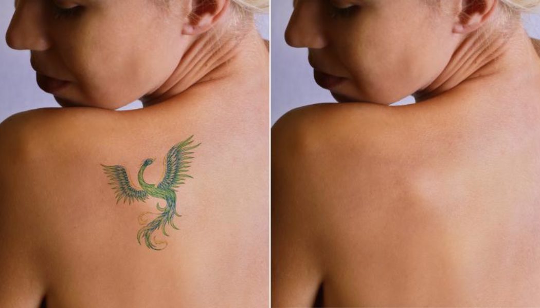 10 Best Clinics for Laser Tattoo Removal in Philippines [2023 Prices]