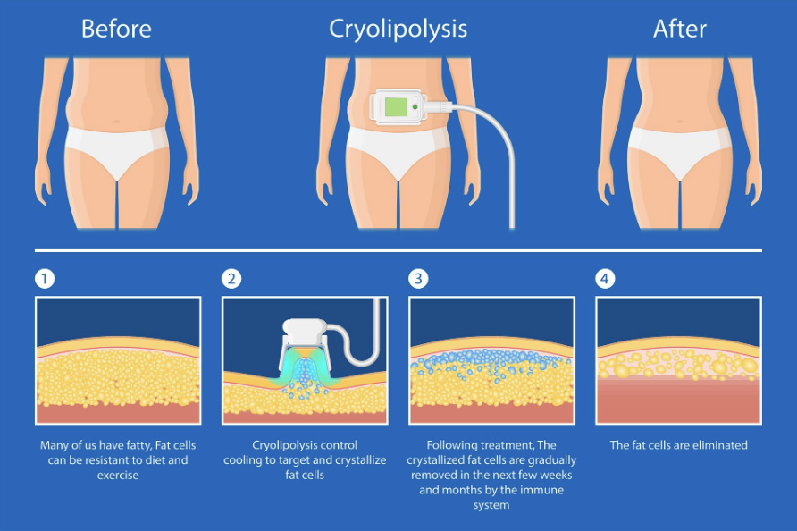 What happens during a CoolSculpting session?