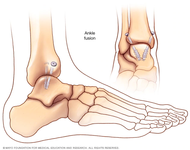 Ankle Suregry