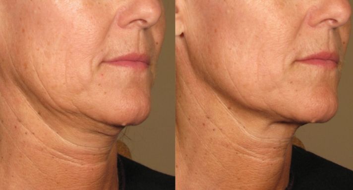 Wrinkle Treatment, Before and After