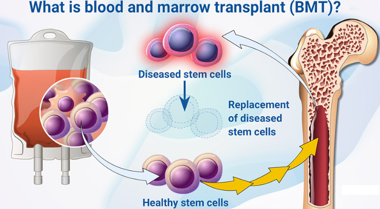 What is a blood and bone marrow transplant (BMT)?