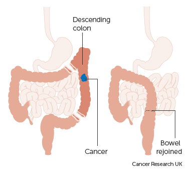 Surgery to remove the left side of the colon is called a left hemi colectomy. 