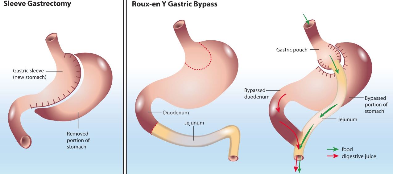 Types of Bariatric Surgery