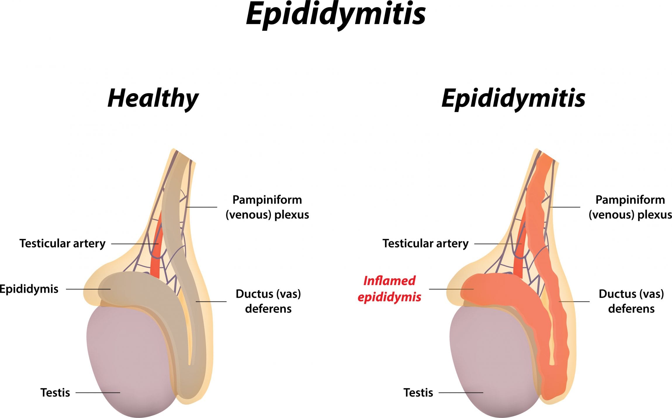 Epididymal Cyst Removal