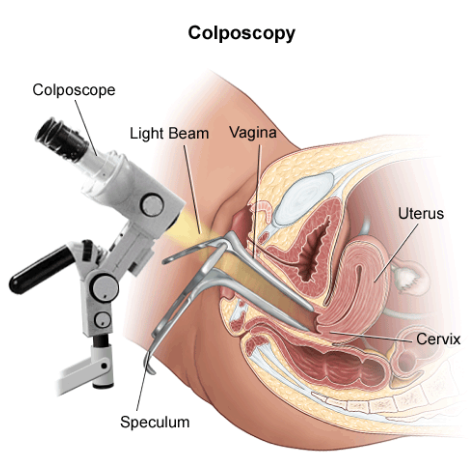 Colposcopy Procedure
