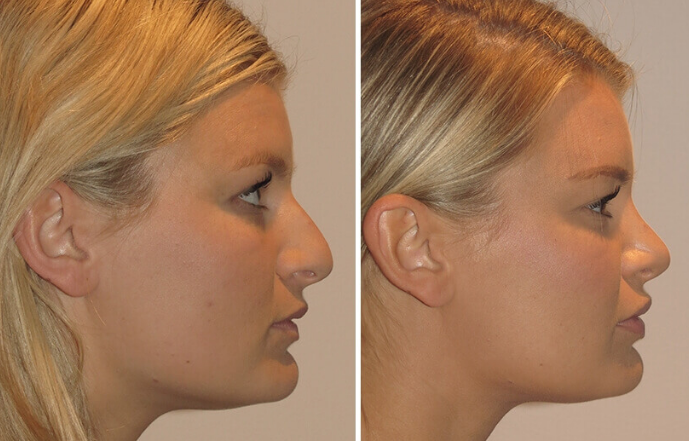 Nose Implant Before and After