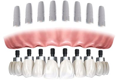 All-On-8 Dental Implants