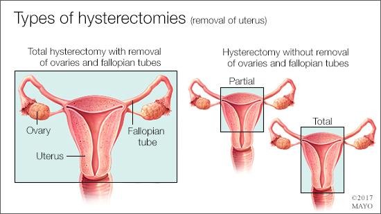 Types of Hysterectomies