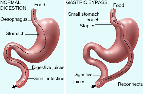 Gastric Bypass Diagram