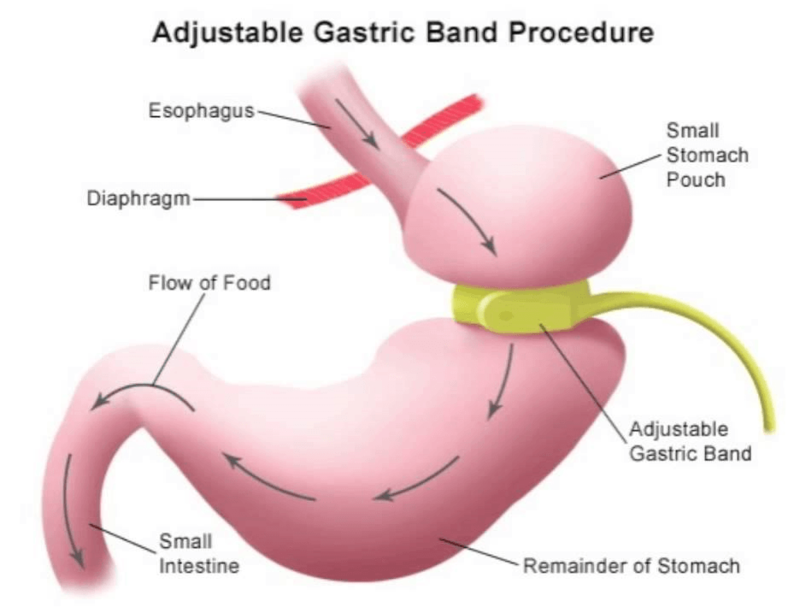 Gastric Band Diagram