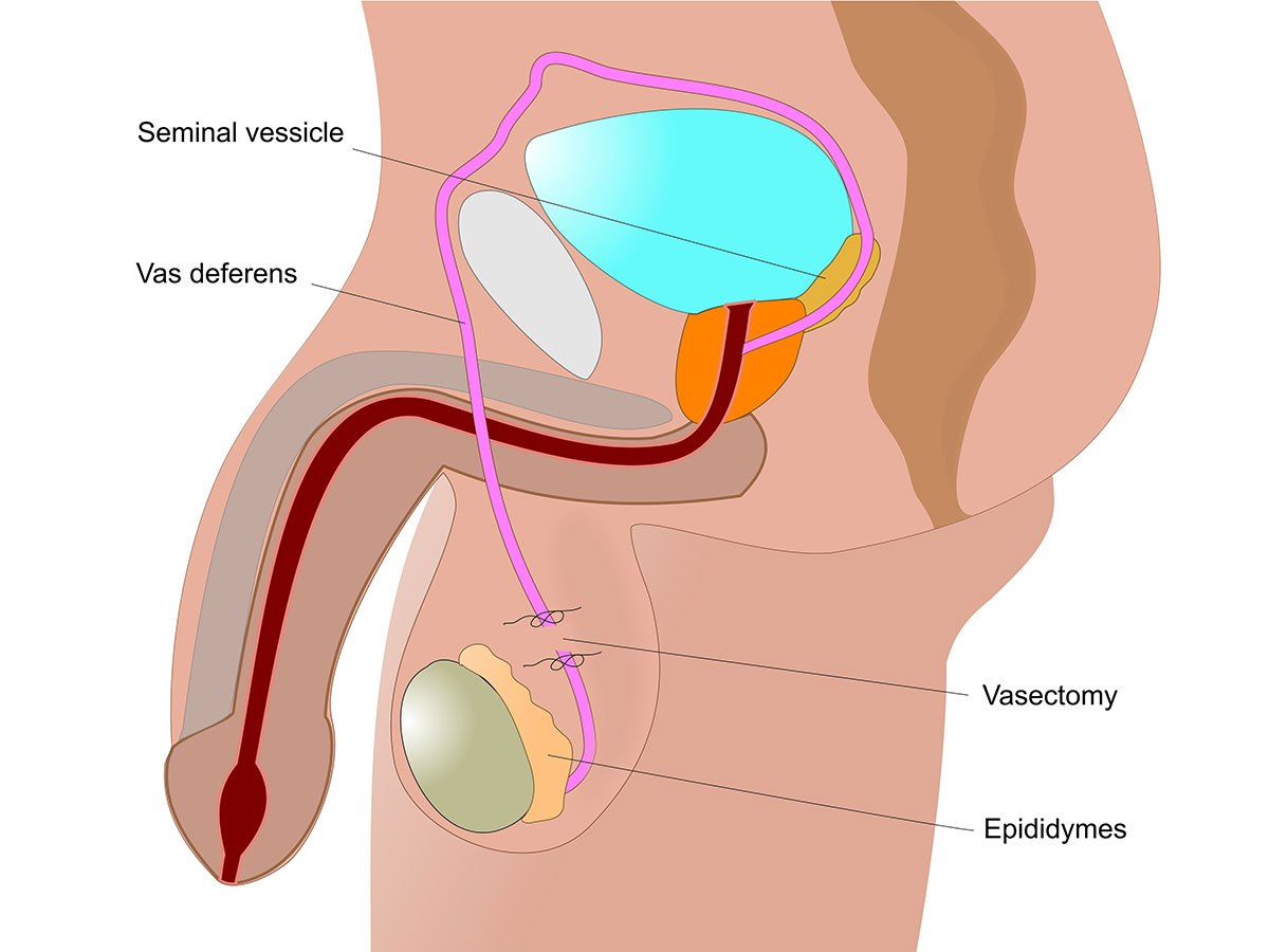 Vasectomy