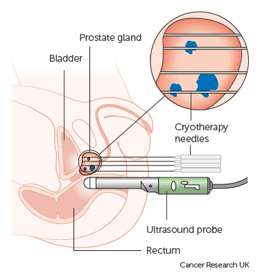 Cryotherapy for Prostate Cancer