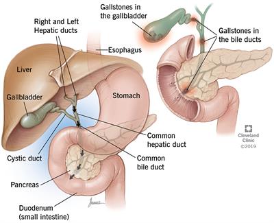 Gallstones Treatment